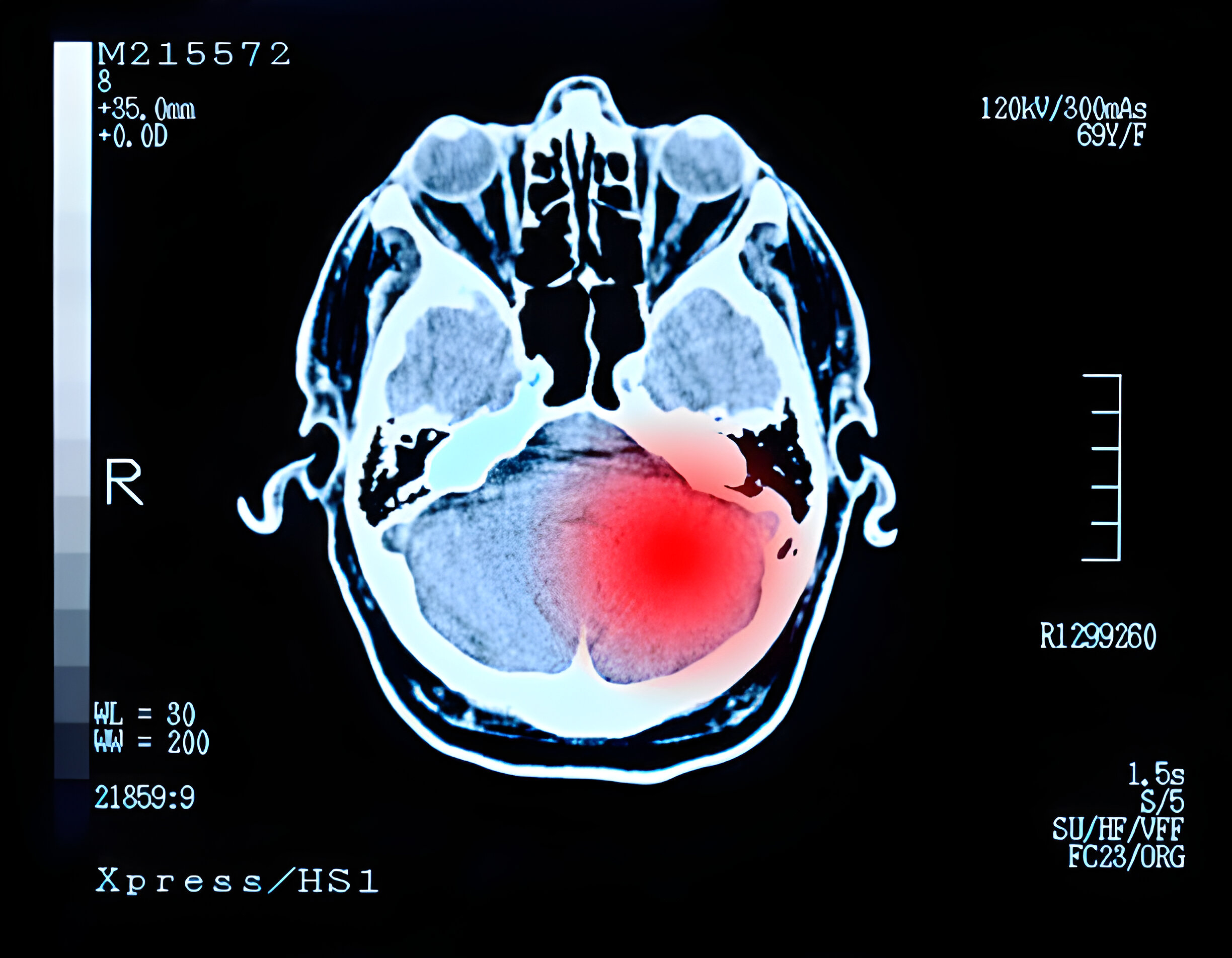 Advanced Traumatic Brain Injury Scan Services in Florida
