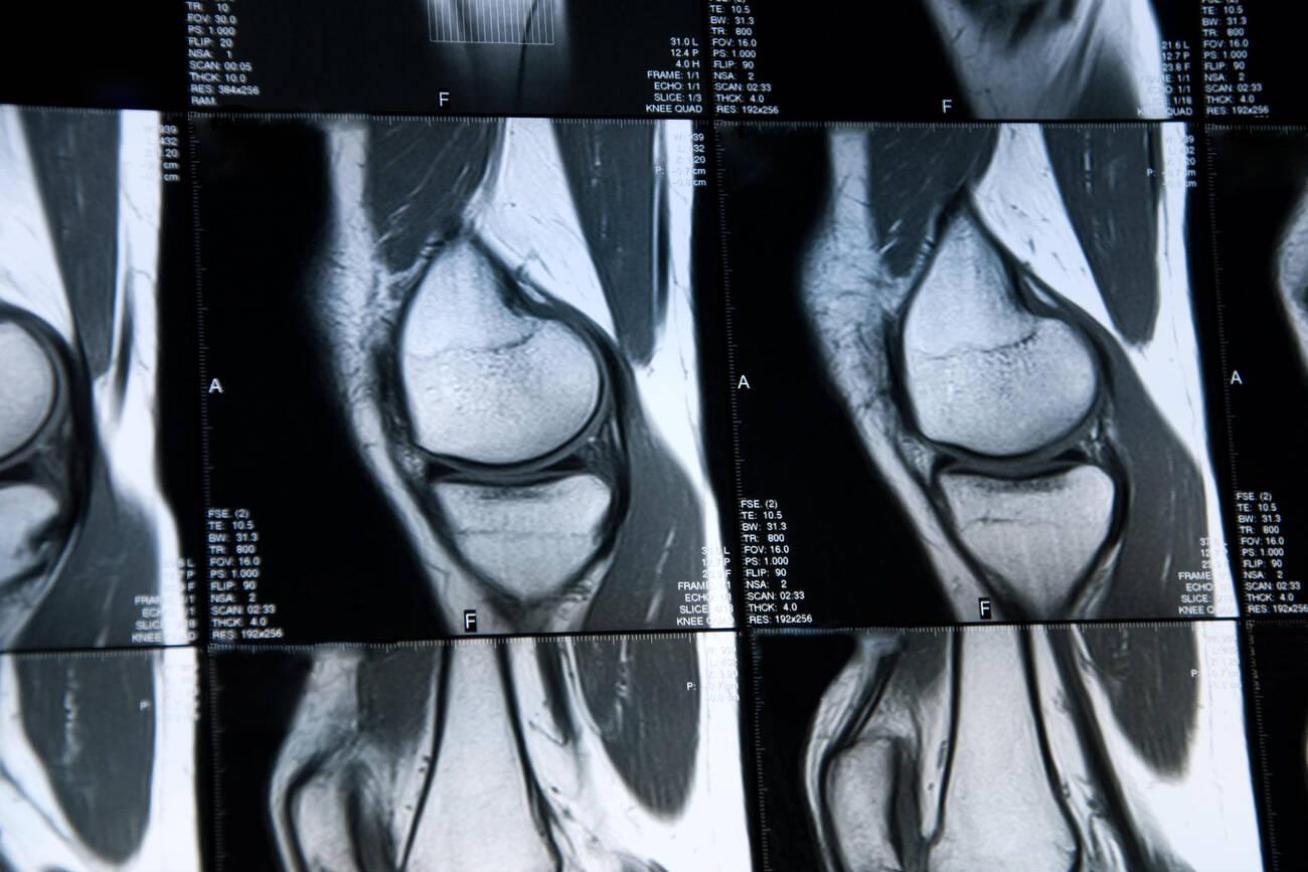 How to Understand Your Knee MRI Results?