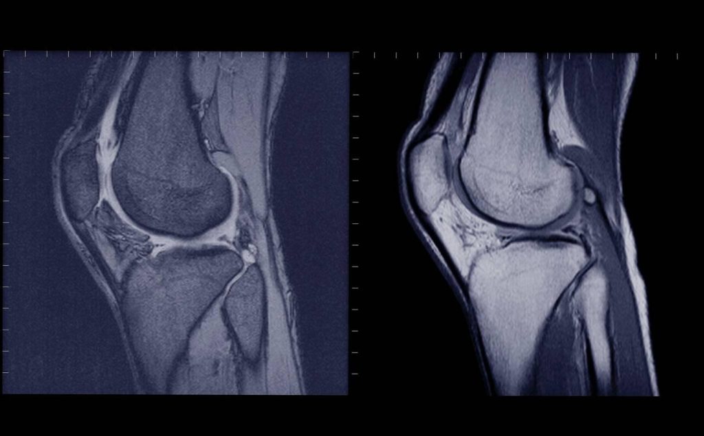 How to Understand Your Knee MRI Results?