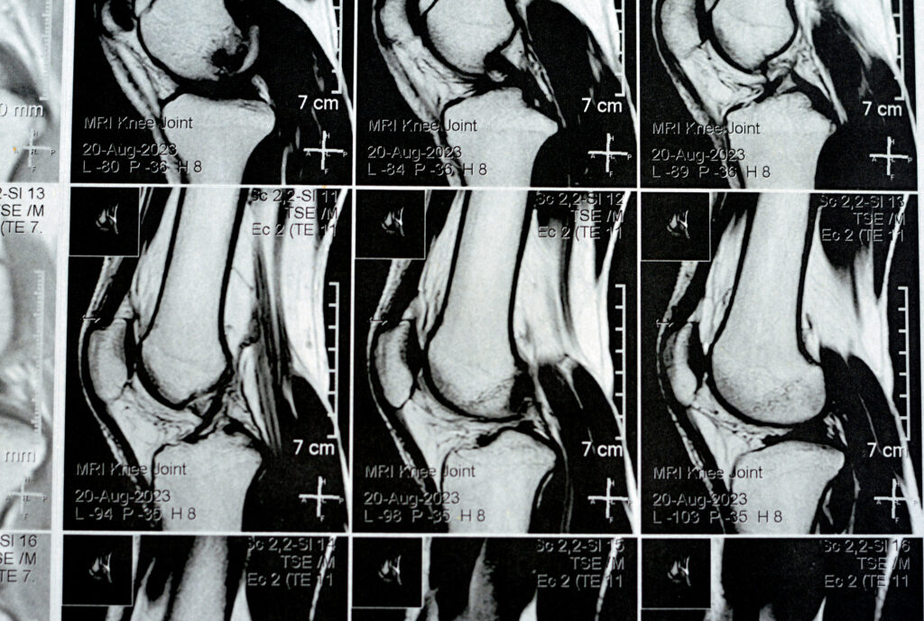 MRI for Joint Pain and Inflammation: What You Need to Know