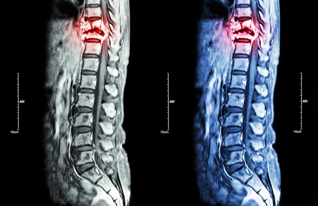 How a Spine MRI Can Help Diagnose Your Back Pain | Precision MRI Group