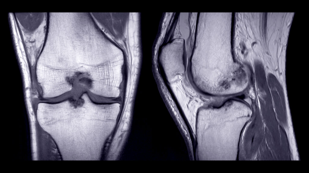 How a Knee MRI Helps Diagnose Sports and Injury Pain