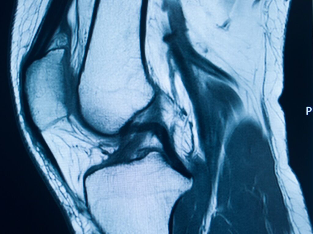 ACL Tear MRI Scan: Know When You Need One | Precision MRI Group