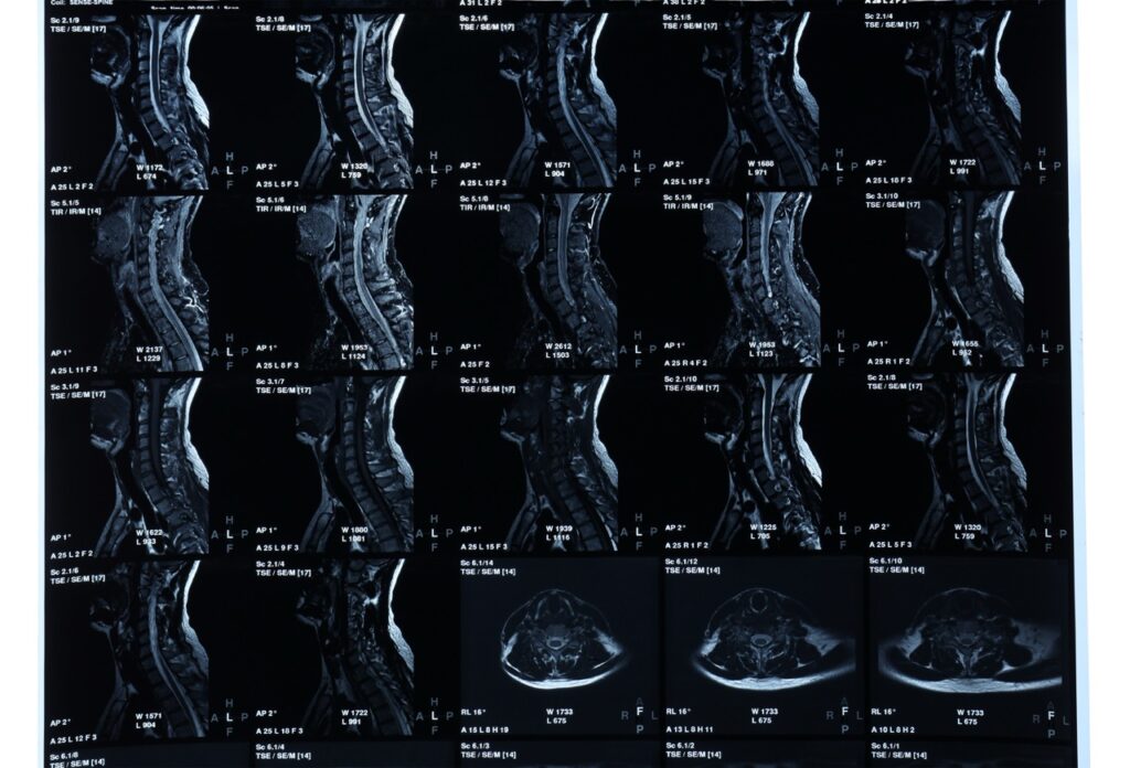5 Things to Know About Your Cervical MRI | Precision MRI Group
