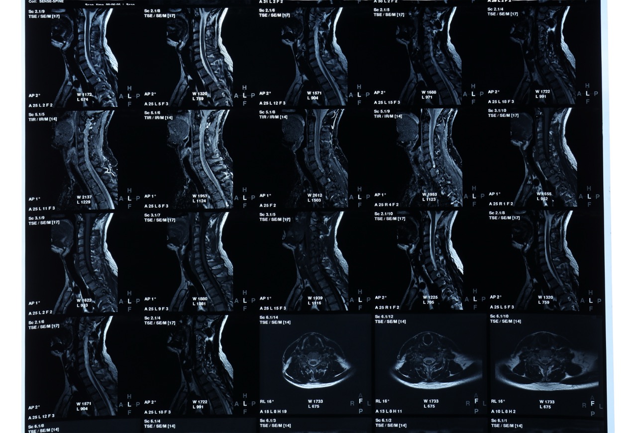 5 Things to Know About Your Cervical MRI | Precision MRI Group