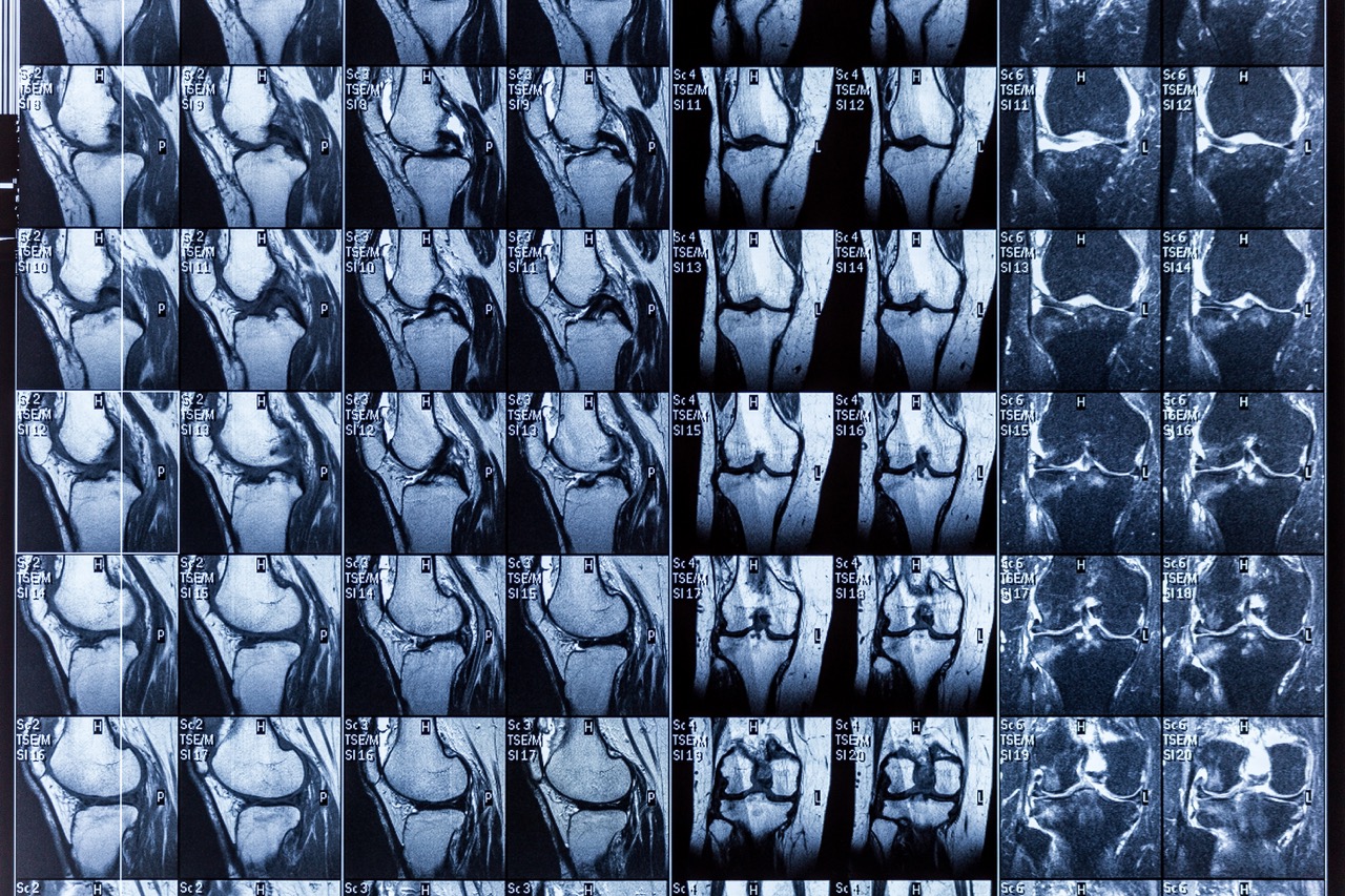 Knee MRI in Port St. Lucie | Same-Day Scans and Self-Pay Pricing | Precision MRI Group