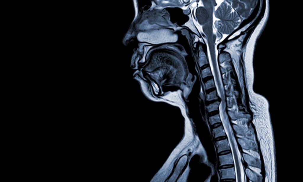 When Should I Get a Cervical MRI?