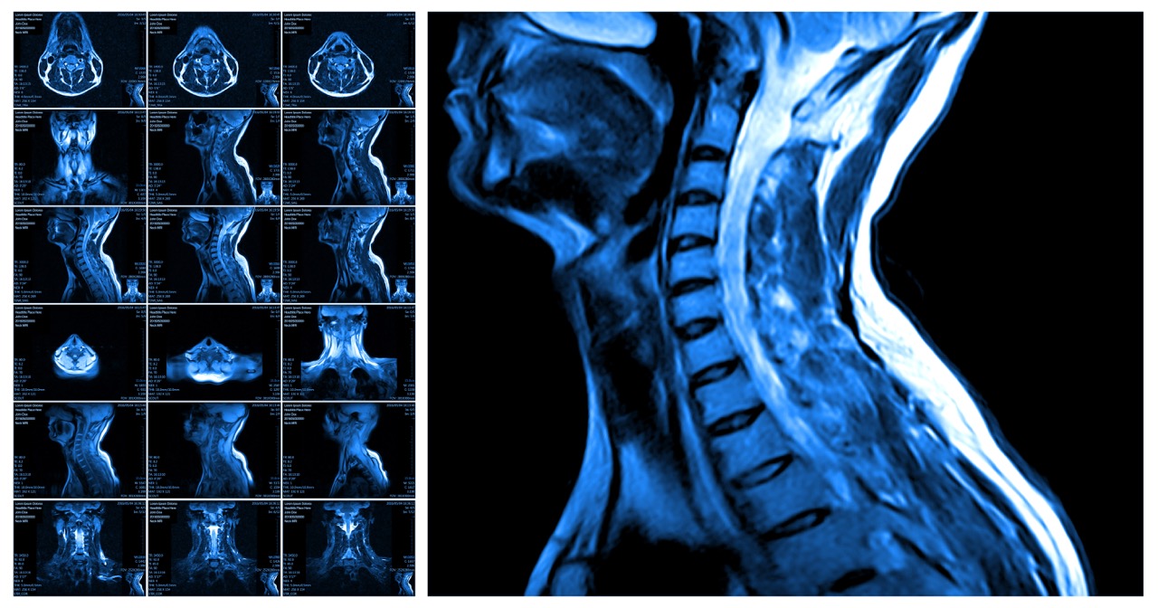 MRI for Neck Pain: Signs Your Doctor Should Order Imaging Now